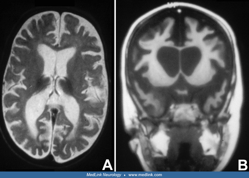 Batten Disease MedLink Neurology Batten Disease MedLink Neurology